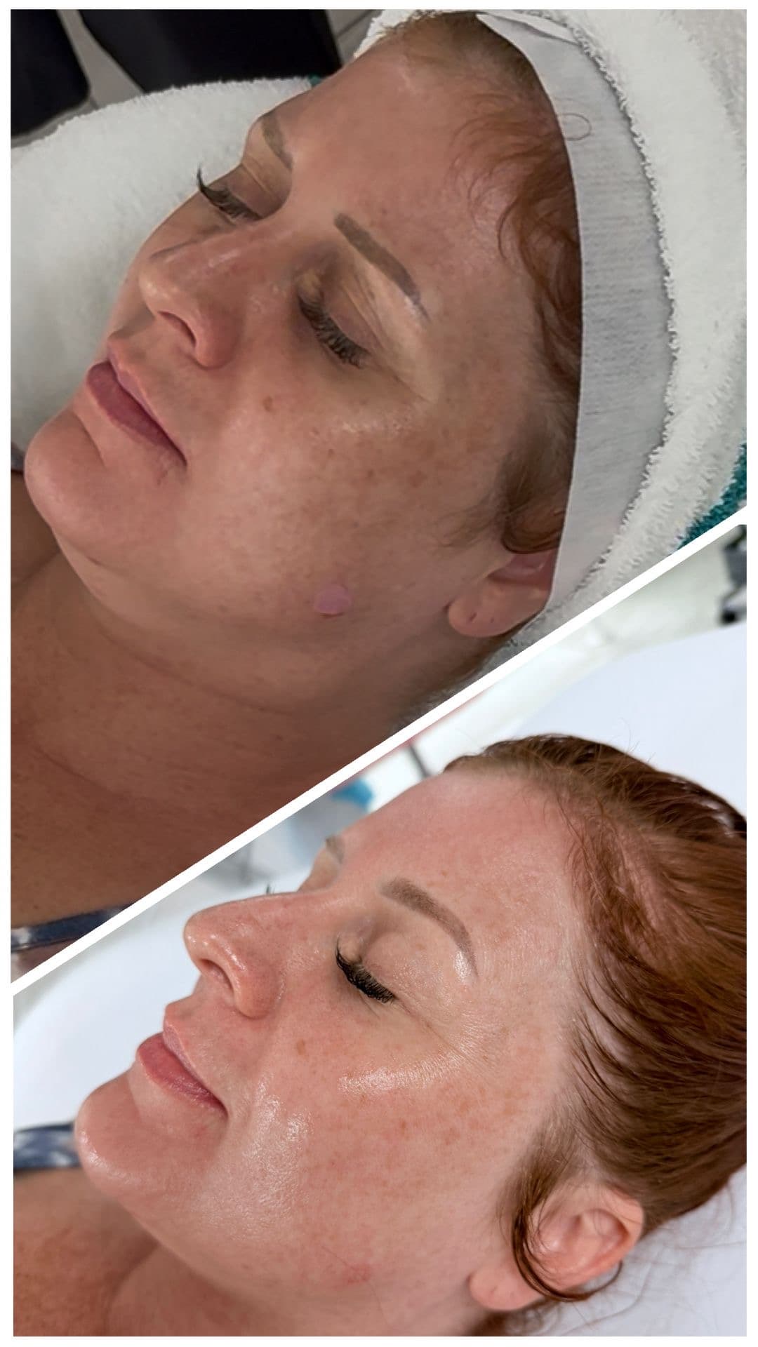 Before-and-after of a customized facial at Glow & Thread — uneven tone and pigmentation transformed into clear, glowing skin