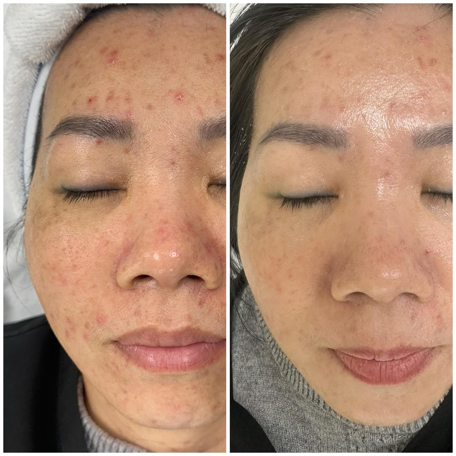 Hydra Facial transformation — clearer, brighter skin after multiple sessions