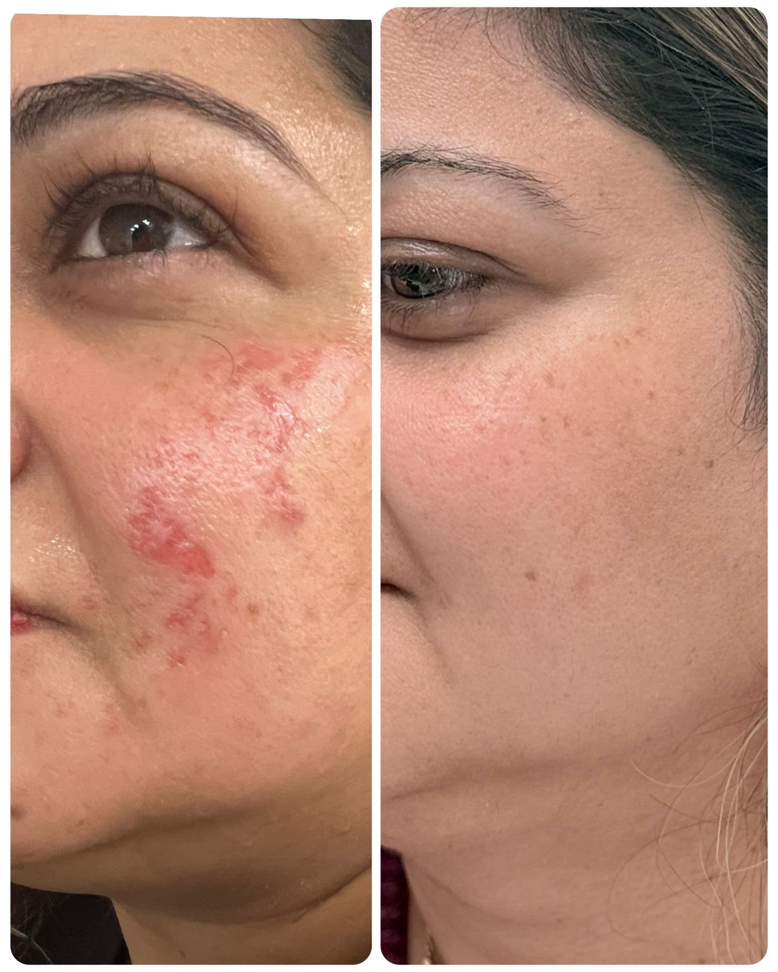 Procell Micro-Channeling result — visibly reduced scarring and redness, smoother and brighter cheek